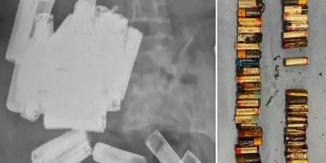 This woman ate 55 batteries, the doctor did an X-ray, then lost consciousness