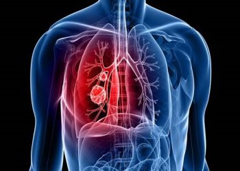 lung cancer