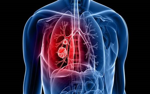 lung cancer