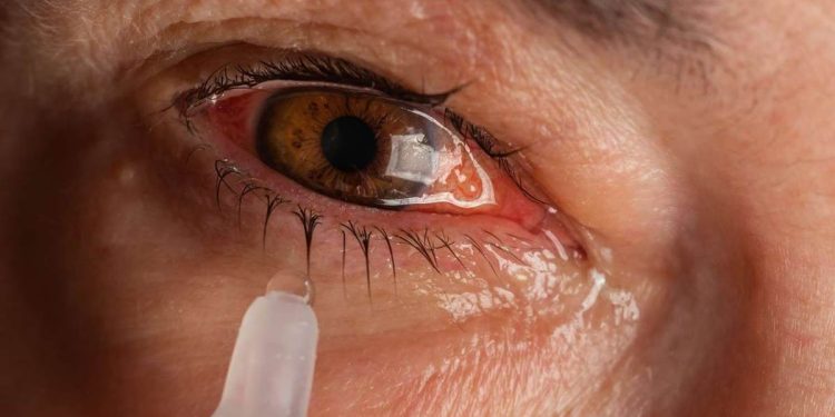 Eye Flu Home Remedies: ਬਰਸਾਤ ਦੇ ਮੌਸਮ 'ਚ ਆਈ ਫਲੂ ਸਮੇਤ ਕਈ ਸੂਬਿਆਂ 'ਚ ਮਹਾਮਾਰੀ ਵਾਂਗ ਫੈਲ ਰਿਹਾ ਹੈ। ਜ਼ਿਆਦਾਤਰ ਲੋਕ ਅੱਖਾਂ ਦੇ ਫਲੂ ਕਾਰਨ ਪ੍ਰੇਸ਼ਾਨ ਹਨ। ਆਈ ਫਲੂ ਦੇ ਲੱਛਣਾਂ ਦੀ ਗੱਲ ਕਰੀਏ ਤਾਂ ਇਸ ਬਿਮਾਰੀ ਦੇ ਜ਼ਿਆਦਾਤਰ ਲੋਕ ਅੱਖਾਂ ਵਿੱਚ ਪਾਣੀ ਆਉਣਾ, ਅੱਖਾਂ ਵਿੱਚ ਦਰਦ ਅਤੇ ਡੰਗਣ, ਅੱਖਾਂ ਵਿੱਚ ਲਾਲੀ, ਅੱਖਾਂ ਵਿੱਚ ਸੋਜ, ਅੱਖਾਂ ਵਿੱਚ ਪਸ ਆਦਿ ਲੱਛਣਾਂ ਨਾਲ ਜੂਝ ਰਹੇ ਹਨ।