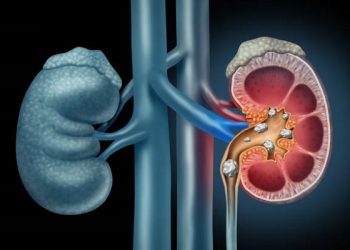 Human Kidney stones medical concept as an organ with painful crystaline mineral formations as a medicine symbol with a cross section with 3D illustration elements.