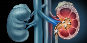 Human Kidney stones medical concept as an organ with painful crystaline mineral formations as a medicine symbol with a cross section with 3D illustration elements.