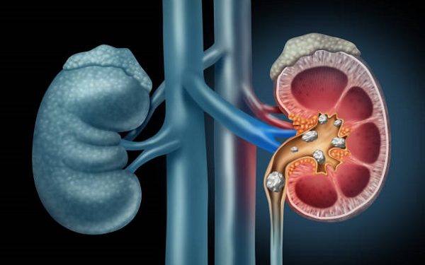 Human Kidney stones medical concept as an organ with painful crystaline mineral formations as a medicine symbol with a cross section with 3D illustration elements.